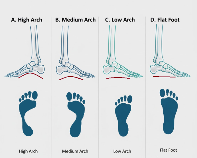 Four foot profiles (high, medium, low, flat) with corresponding wet footprints showing contact patterns