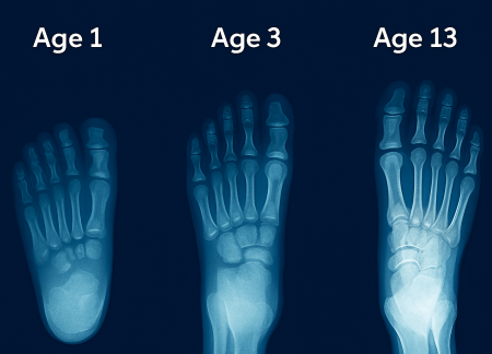 3-panel X-ray progression: Age 1 (cartilage), Age 3 (heel/metatarsal bones), Age 13 (full adult skeleton)