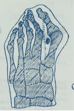 Hallus Vagus results in shortened toe tendon like a howstring (dotted line) plus displacment of sesamoid bones under great toe joint