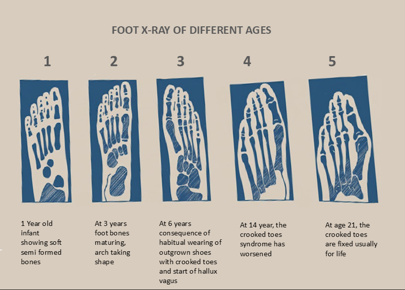 Grayscale X-ray sequence across five panels showing hallux valgus development from infancy to adulthood