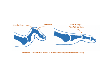Hammer Toe Verse Normal Toe - An obvious problem in shoe fitting