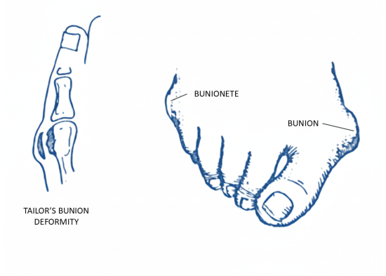Tailors Bunion Deformity