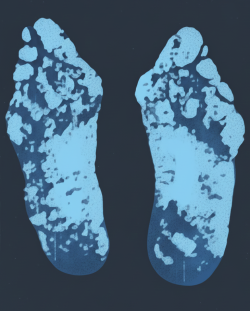 Hallus Vagus. Severe deformity of the great toe joint. Note that bent toes have become useless. Note also bony prominence of metatarsal heads. A painful, sensitive foot