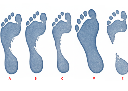 Side-by-side wet footprints comparing a normal arched foot to a flat pes planus print