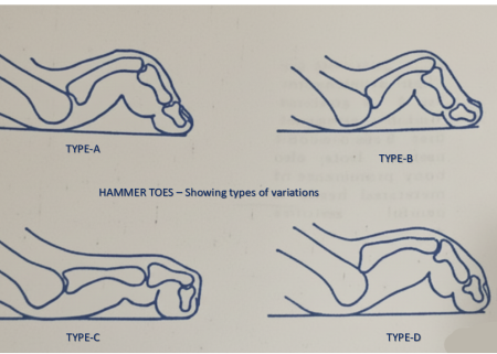Line drawing sequence of four hammer toe types progressing from mild flexion to rigid corn formation, compared to a normal toe with a child's out-toed foot inset