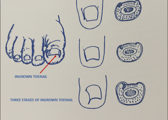 Three-panel diagram depicting the progression of an ingrown toenail from initial swelling to severe infection