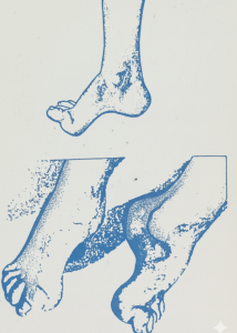 Side profile of a high-arched pes cavus foot with clawed toes, callus buildup, and an outline of an accommodating extra-depth shoe
